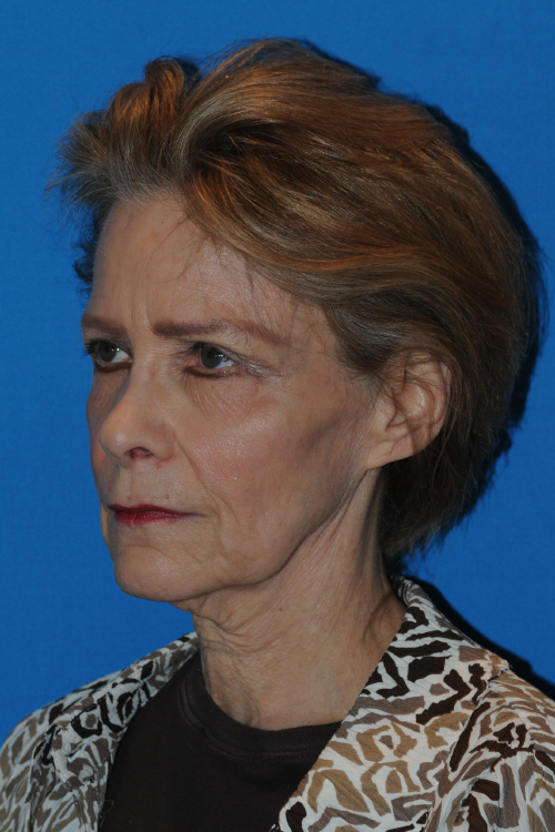 Before Facelift