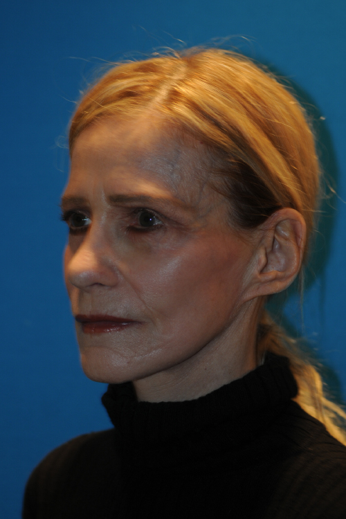 After Facelift