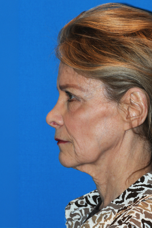 Before Facelift