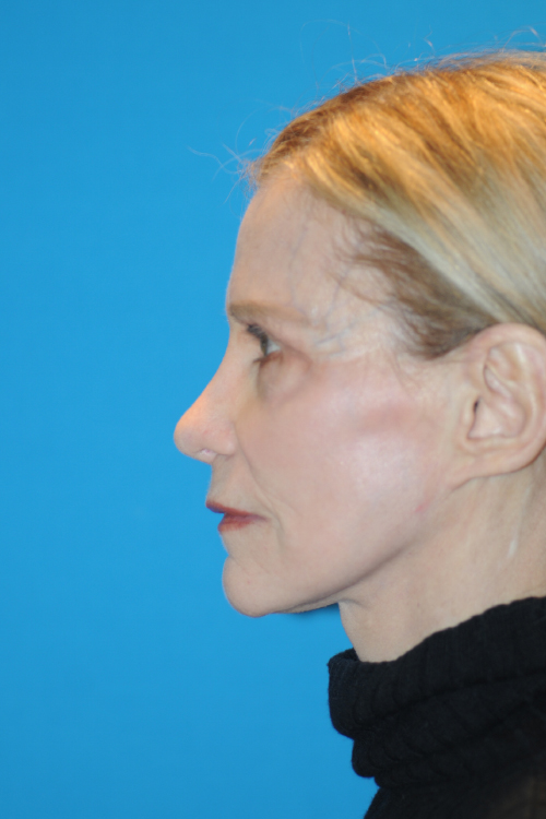 After Facelift