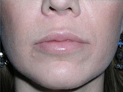 Lip Augmentation After Lip Augmentation After
