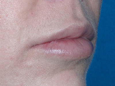 Lip Augmentation After Lip Augmentation After