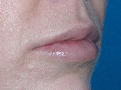 Lip Augmentation After