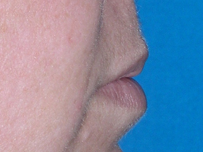 Lip Augmentation Before