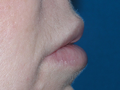 Lip Augmentation After Lip Augmentation After