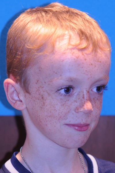 After Otoplasty
