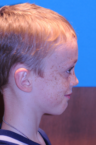 After Otoplasty