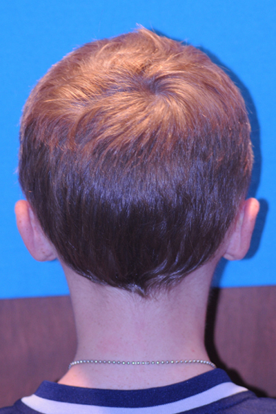 After Otoplasty