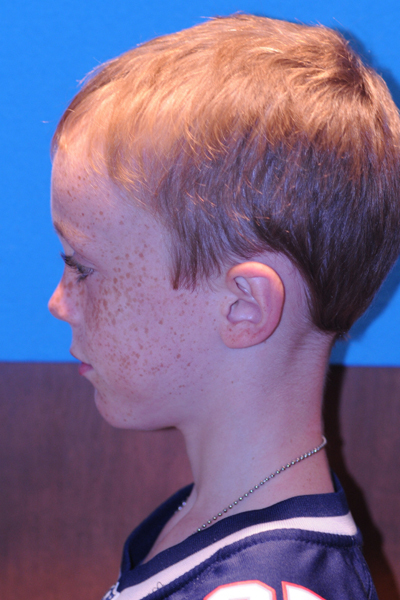 After Otoplasty