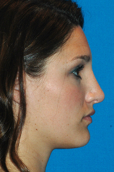 Rhinoplasty After