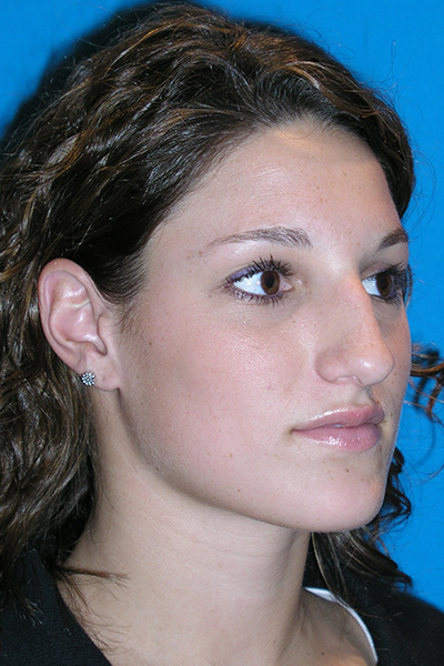 Rhinoplasty Before