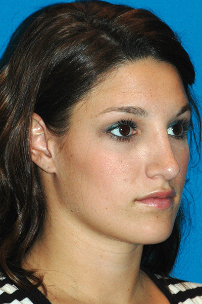 Rhinoplasty After Rhinoplasty After