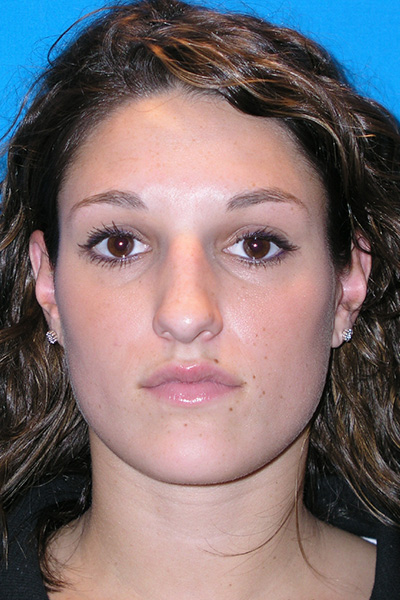 Rhinoplasty Before Rhinoplasty Before