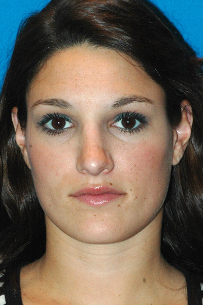 Rhinoplasty After Rhinoplasty After