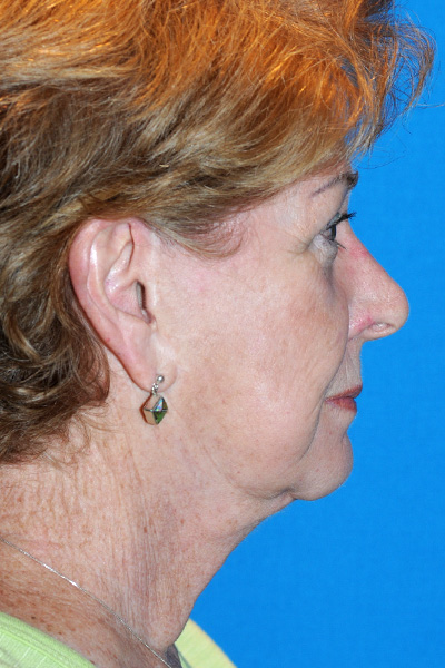 Revision Facelift, Rhinoplasty Before