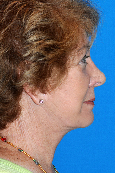 Revision Facelift, Rhinoplasty After Revision Facelift, Rhinoplasty After