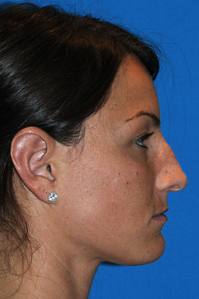 Rhinoplasty Before Rhinoplasty Before