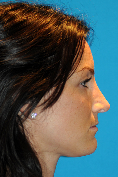 Rhinoplasty After