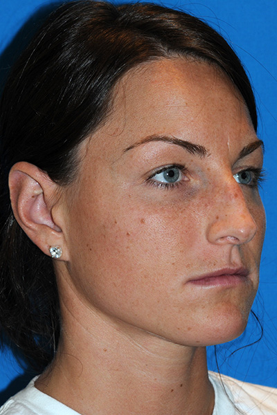 Rhinoplasty Before Rhinoplasty Before