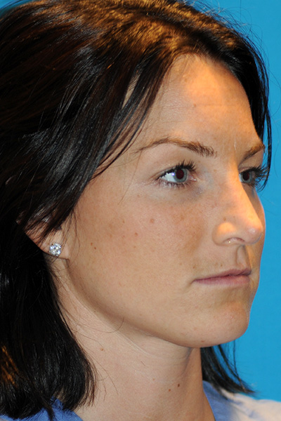 Rhinoplasty After Rhinoplasty After