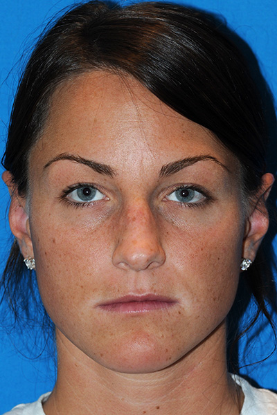Rhinoplasty Before Rhinoplasty Before