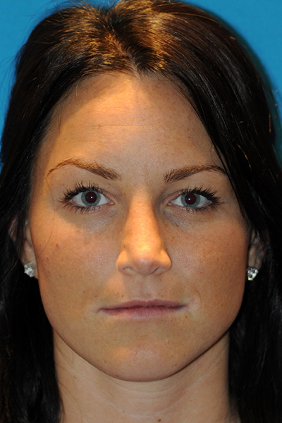 Rhinoplasty After Rhinoplasty After