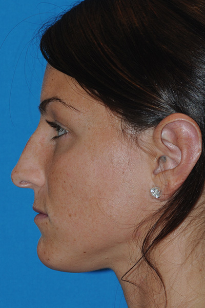 Rhinoplasty Before Rhinoplasty Before