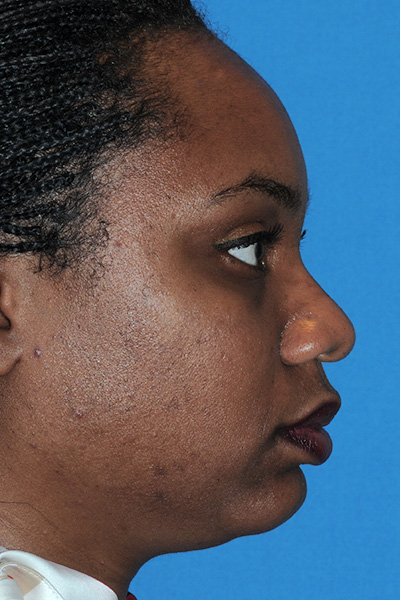 Rhinoplasty Before Rhinoplasty Before