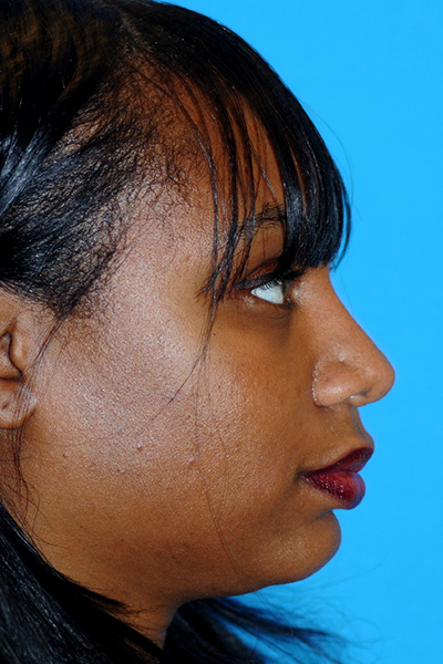 Rhinoplasty After