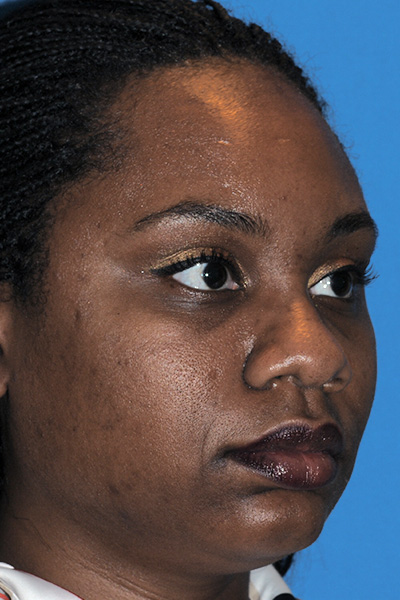 Rhinoplasty Before Rhinoplasty Before
