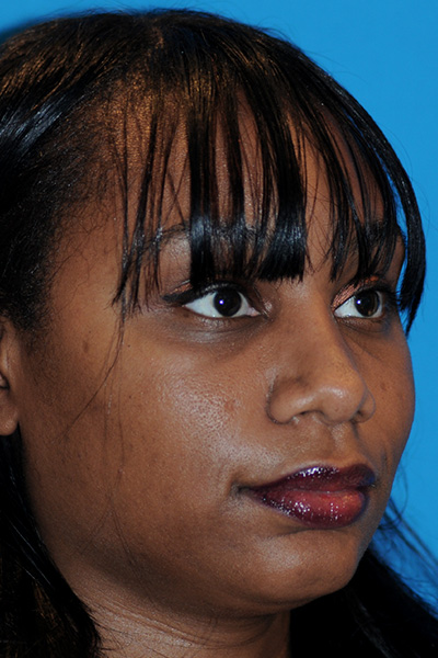 Rhinoplasty After Rhinoplasty After