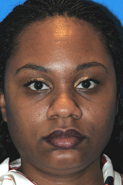Rhinoplasty Before Rhinoplasty Before