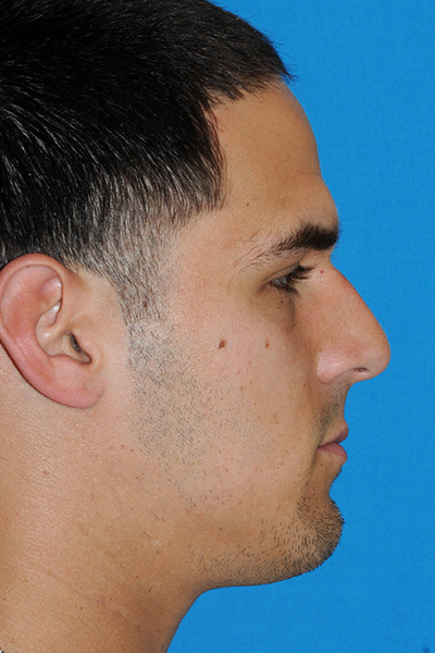 Rhinoplasty Before