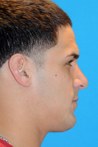 Rhinoplasty After