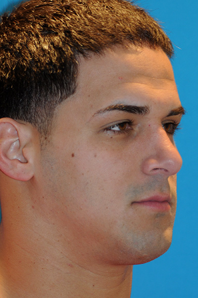 After Rhinoplasty