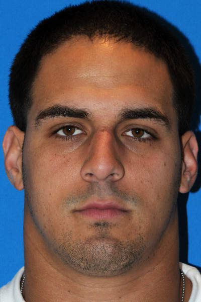 Before Rhinoplasty