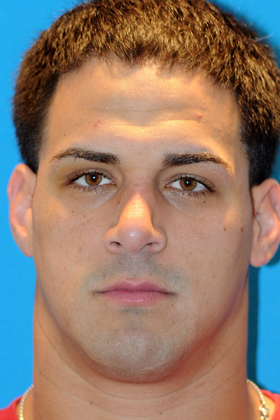 After Rhinoplasty