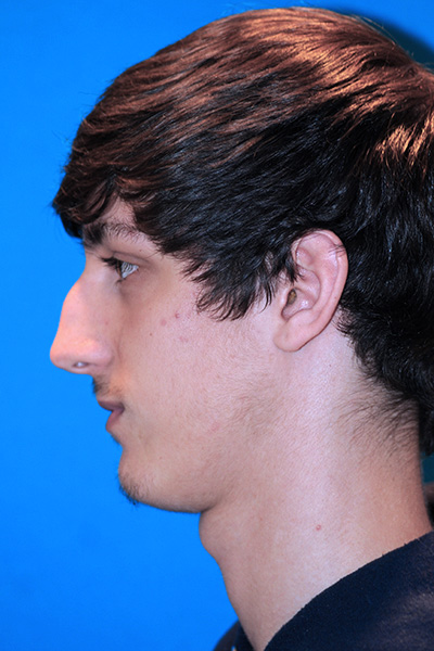 Rhinoplasty Before Rhinoplasty Before