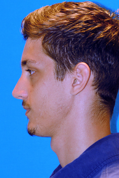 Rhinoplasty After