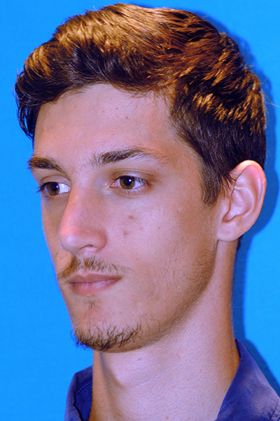 Rhinoplasty After Rhinoplasty After