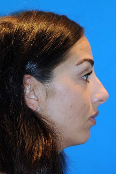 Rhinoplasty Before Rhinoplasty Before