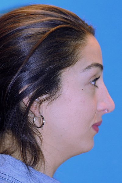 Rhinoplasty After