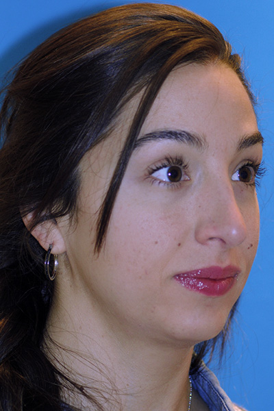 Rhinoplasty After Rhinoplasty After