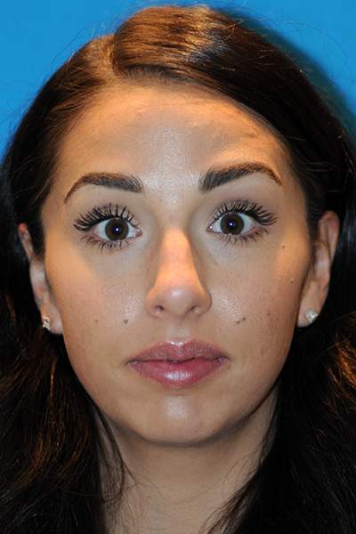 Rhinoplasty Before