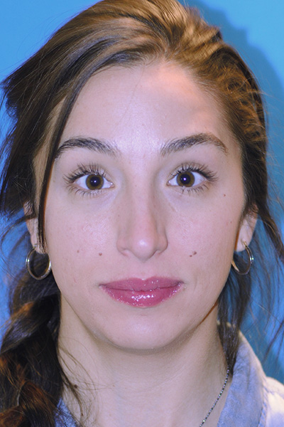 Rhinoplasty After Rhinoplasty After