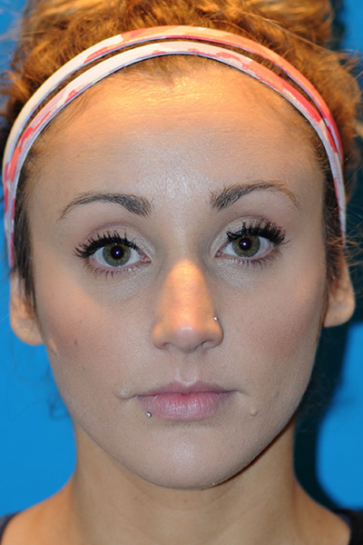 Rhinoplasty Before