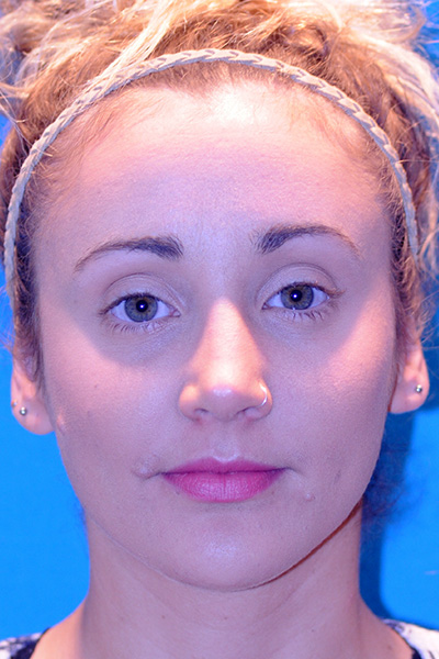 Rhinoplasty After