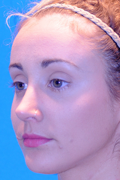 Rhinoplasty After