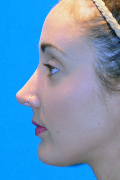 Rhinoplasty After