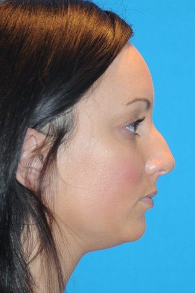 Rhinoplasty Before